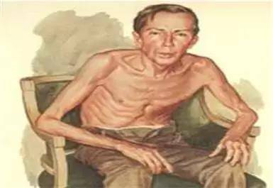 神经系统|为何小脑萎缩共济失调会出现肌肉萎缩?