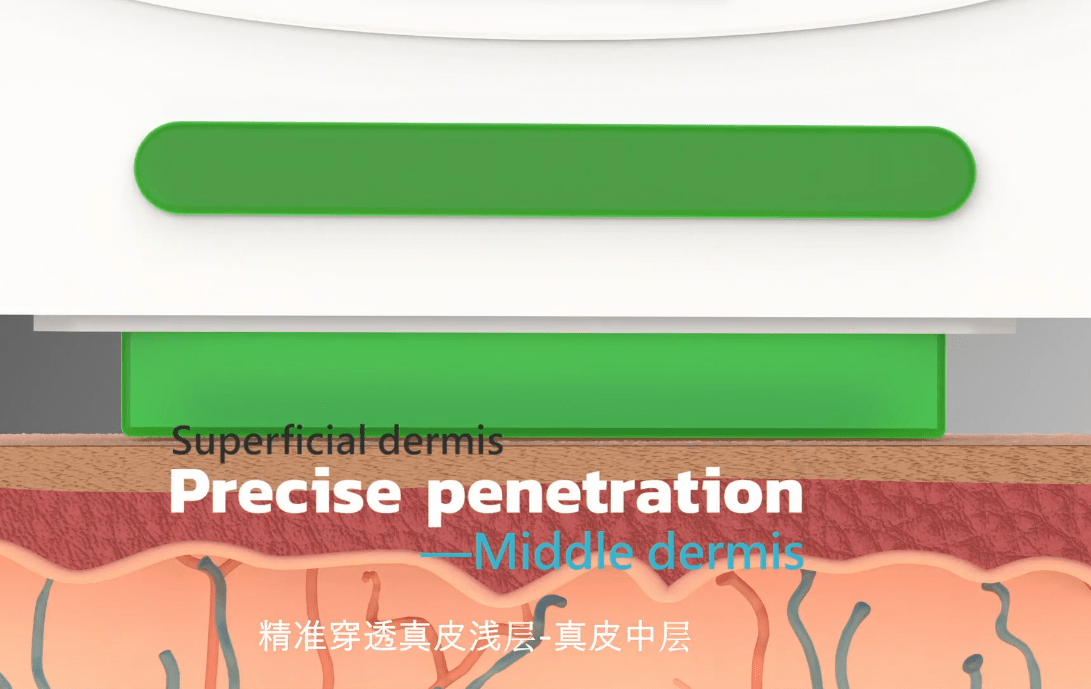 肤质面部皮肤管理项目NIR牛奶光嫩肤体现在哪些方面?