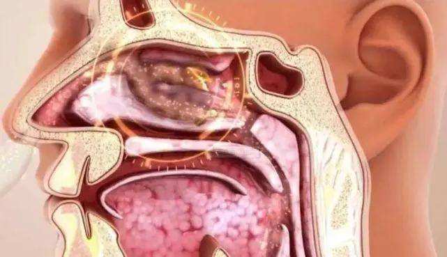 鼻炎发作,呼吸机还能用吗?_阻塞_鼻腔_治疗