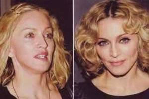 脸部脸部做大拉皮可以挺几年,脸拉皮手术能维持几年~