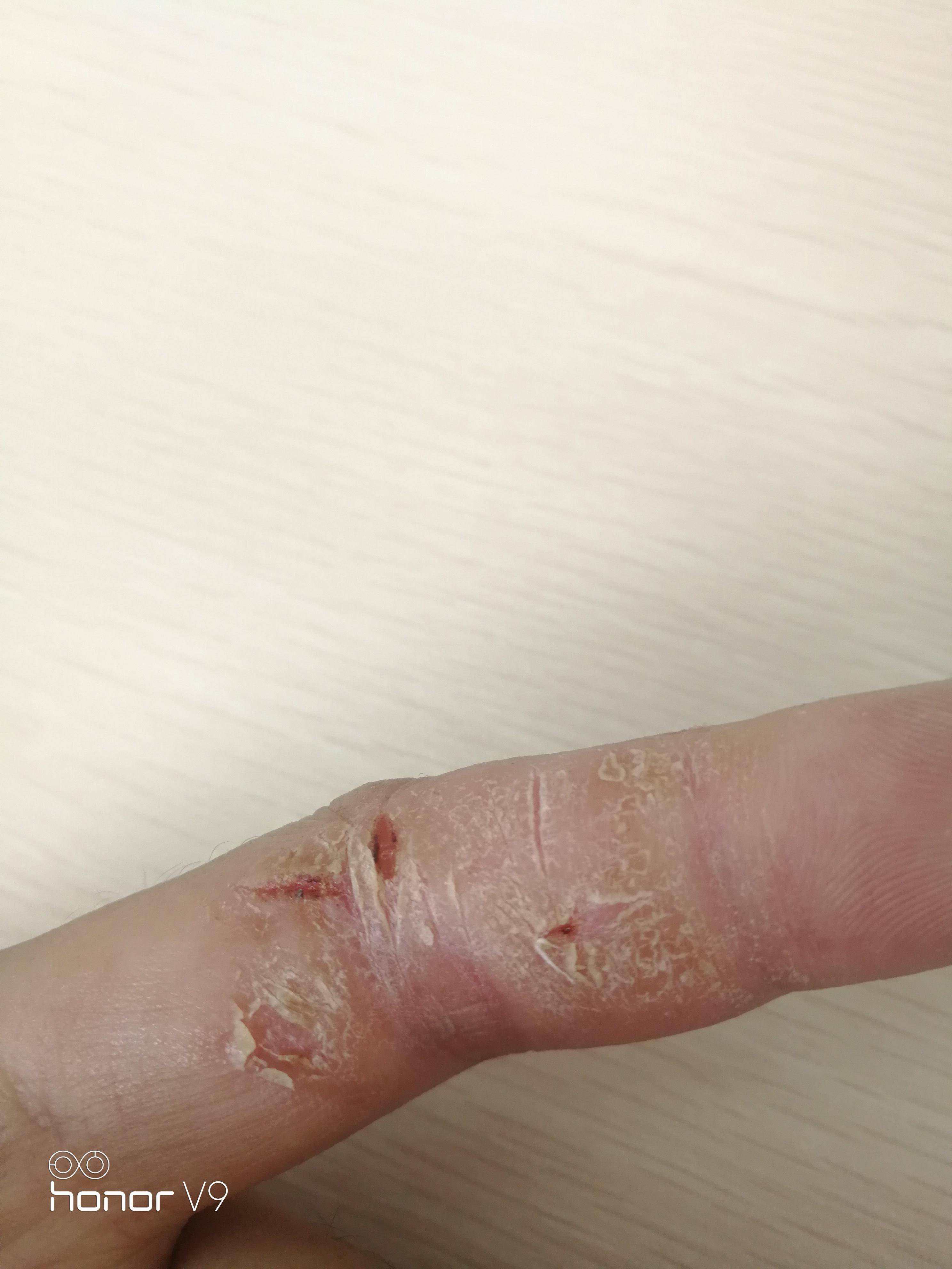 手指干燥起皮容易裂口子是什么原因