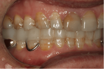 绚彩3d pro临床病例展示丨全口咬合重建一例_爱迪特_患者_技术