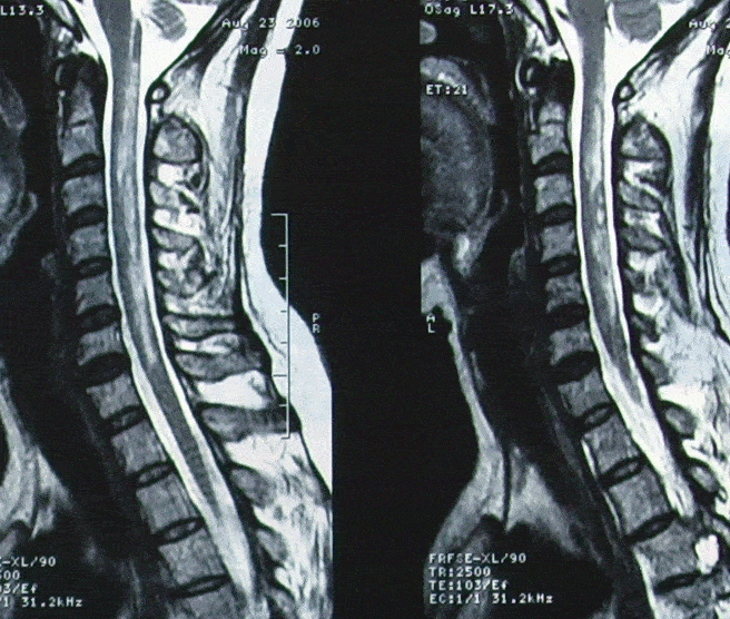 脊髓损伤怎样才能恢复?