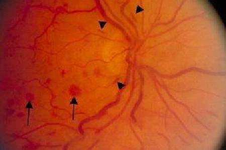 首大聂红平:不同的视网膜出血会有哪些表现