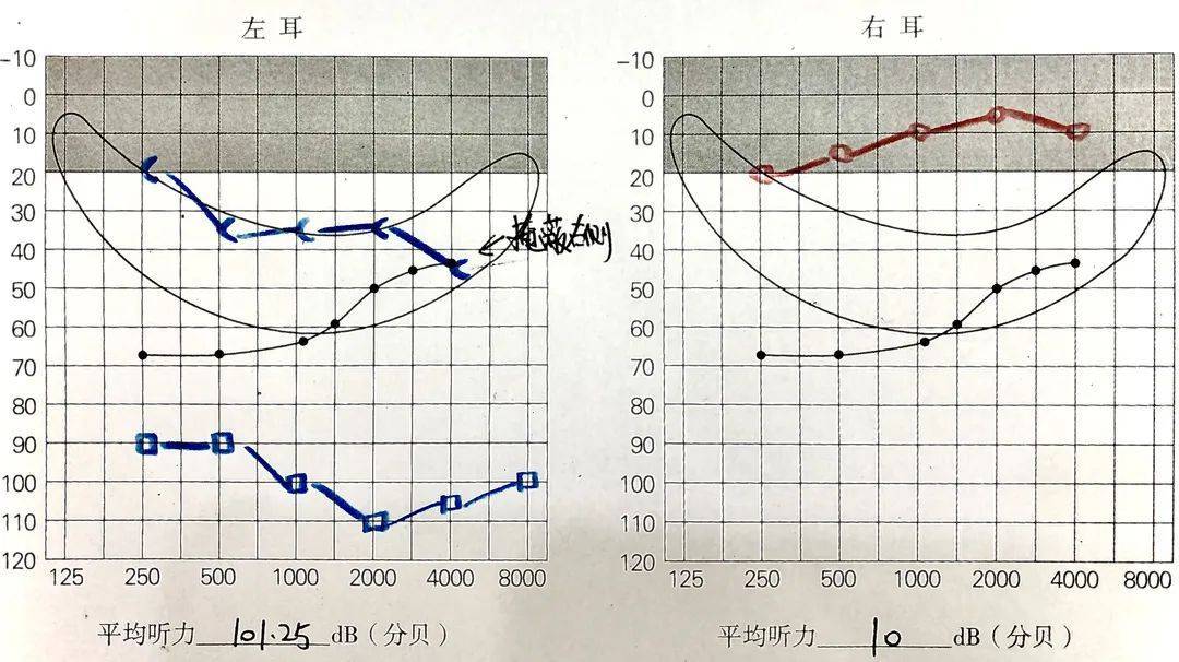 纯音测听需要对刺激电极至少设置t值(阈值水平)和c值(最舒适响度级)