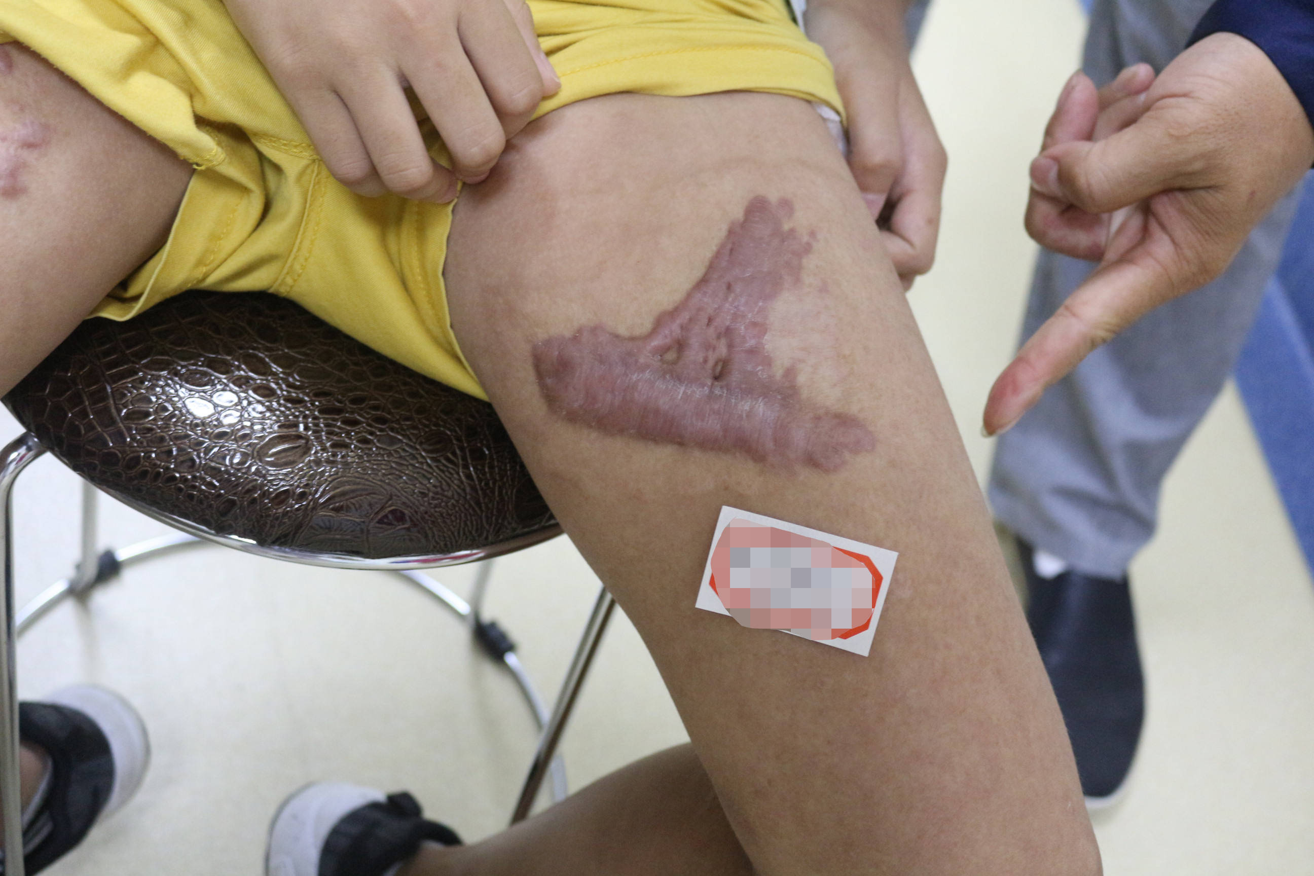 郑州市第二中医院受伤后疤痕凸起原因