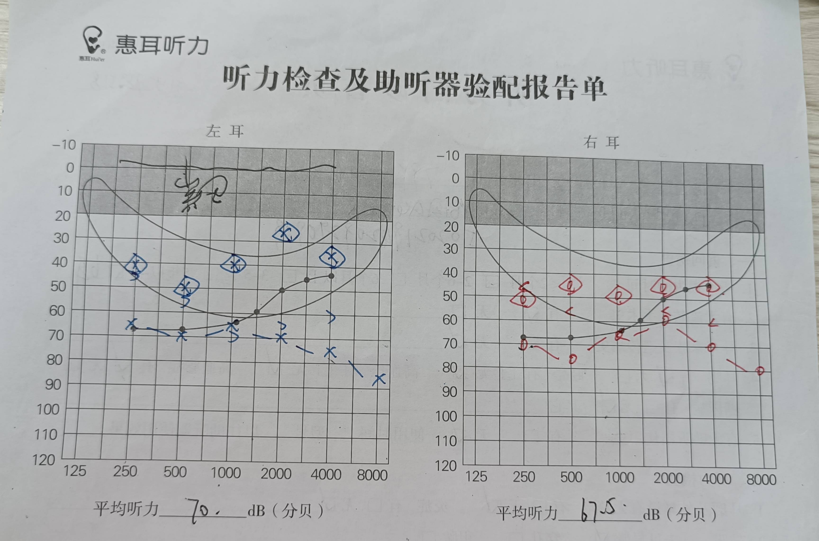 耳镜检查报告图片图片