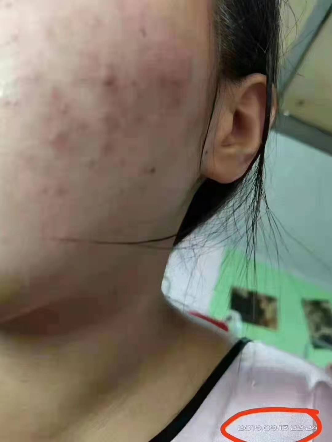 方法董欣薰衣草纯露消炎功效好嘛？痘痘肌敏感肌使用方法