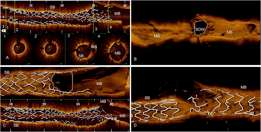 吉林心脏病医院外籍专家合作开展的oct评估dkcrush边支优化技术临床