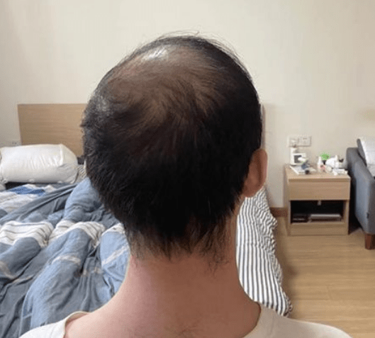 浙江杭州一男子秃顶尝试半月不用洗发水竟长出头发不建议尝试这个方法