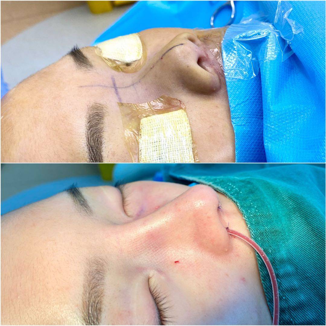 整形医生周建做自体软骨隆鼻这块软骨不建议动