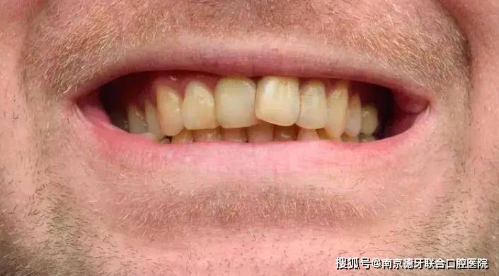 南京德牙联合口腔如何拯救因喝茶变黄的牙齿
