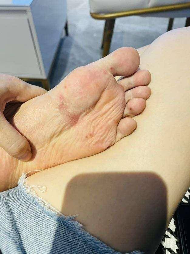 脚上起小水泡,还痒,是怎么回事?脚气吗?