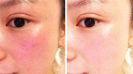 皮肤敏感总是满脸爆红该怎么修复？