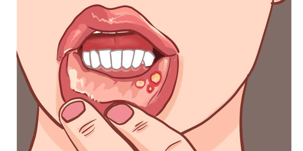 白塞氏病和普通口腔溃疡的区别会不会影响寿命