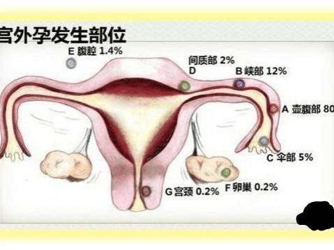 宮外孕可能出現的症狀_輸卵管_陰道_女性