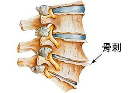 腰椎骨质增生跟腰椎间盘突出一样吗?