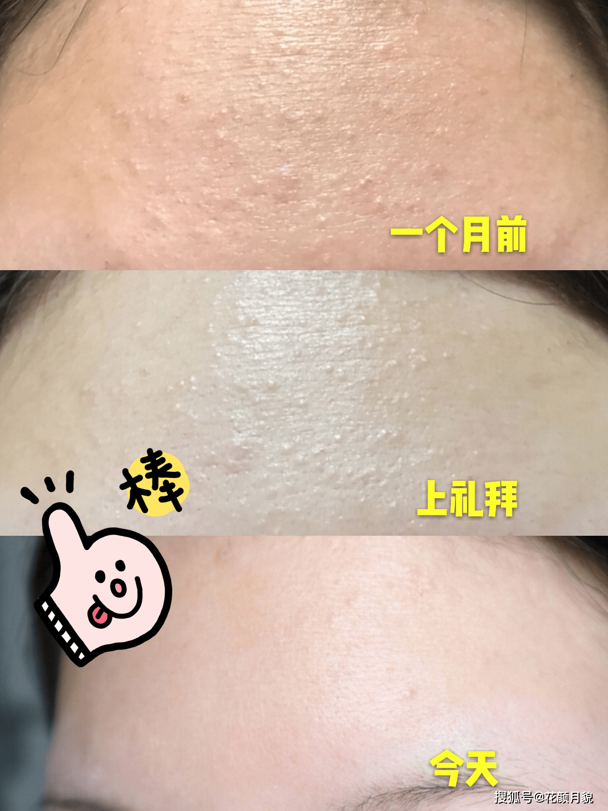 皮脂腺分泌过剩会让油脂充塞毛孔形成角栓,这些角栓慢慢把毛孔撑大