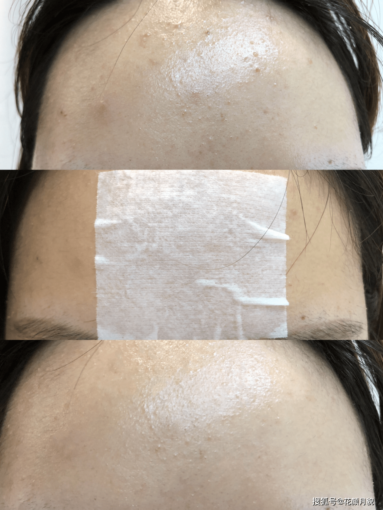 皮脂腺分泌过剩会让油脂充塞毛孔形成角栓,这些角栓慢慢把毛孔撑大