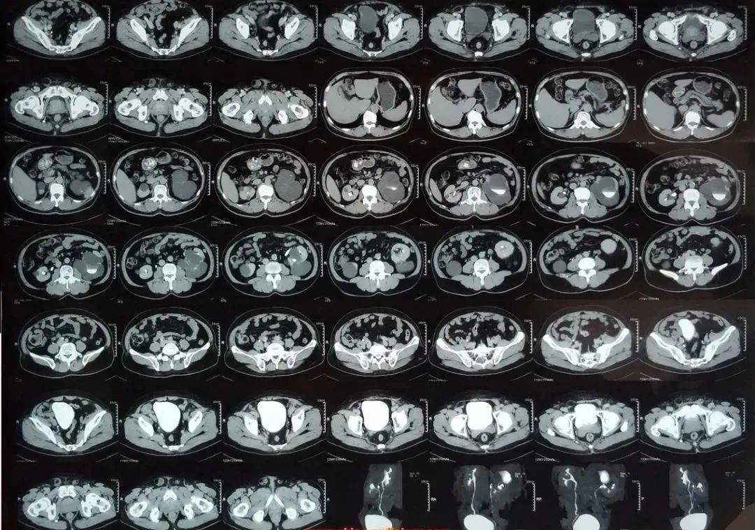 胆道B超图片