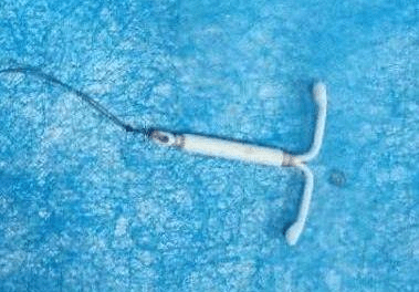 医德佳腺肌症保宫腺肌症上曼月环为什么会自动脱落