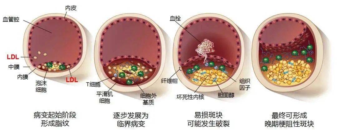 血栓和斑块的区别图片