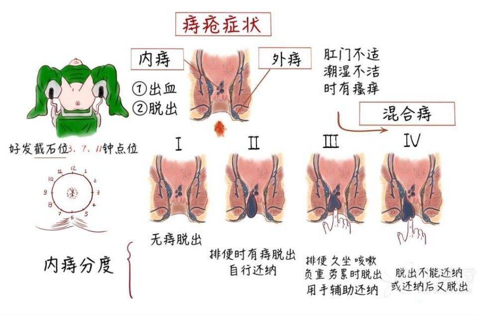 方法很簡單,只需這4步!_大便_星期_屁股