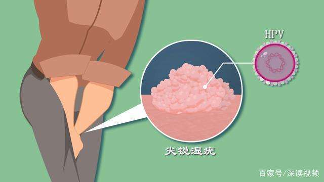 治疗尖锐湿疣用什么药最好？不想再做激光了太疼了，还复发!