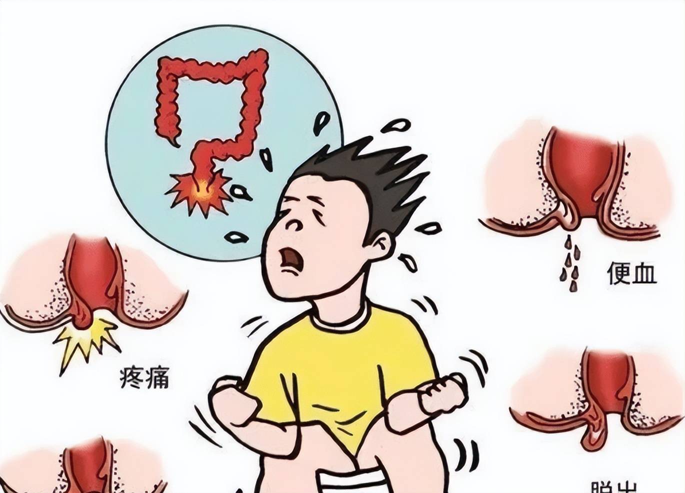 高锰酸钾竟然能缩小痔疮肉球?每天成本只需要几毛钱,亲测有效!