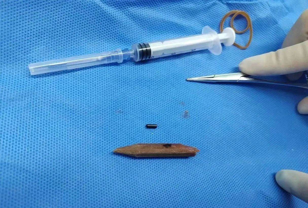 小女孩跌倒后面部肿痛流脓,入院手术取出半截铅笔!_医生_异物_检查