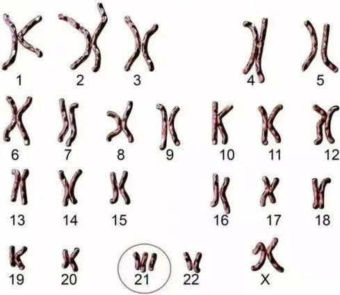 23染色体异常婴儿照片图片