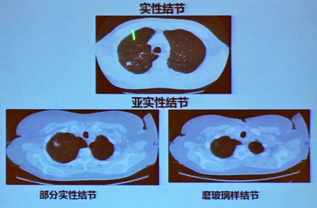 腫瘤科許德璞:肺結節就一定是肺癌嗎?_肺部_人群_醫生