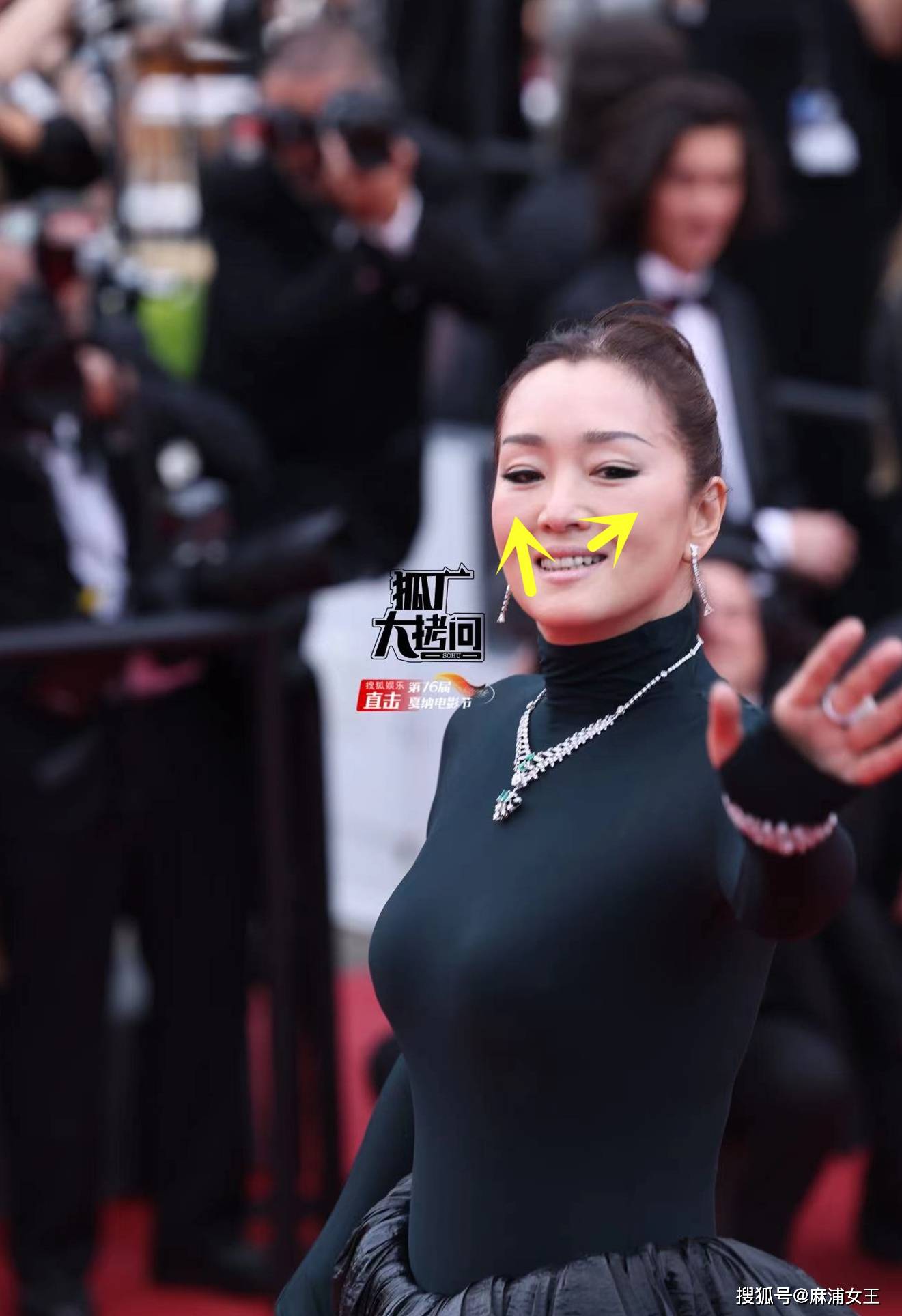 众多明星脸上出现印第安纹,解读印第安纹四大形成原因_面部_影响_韧带