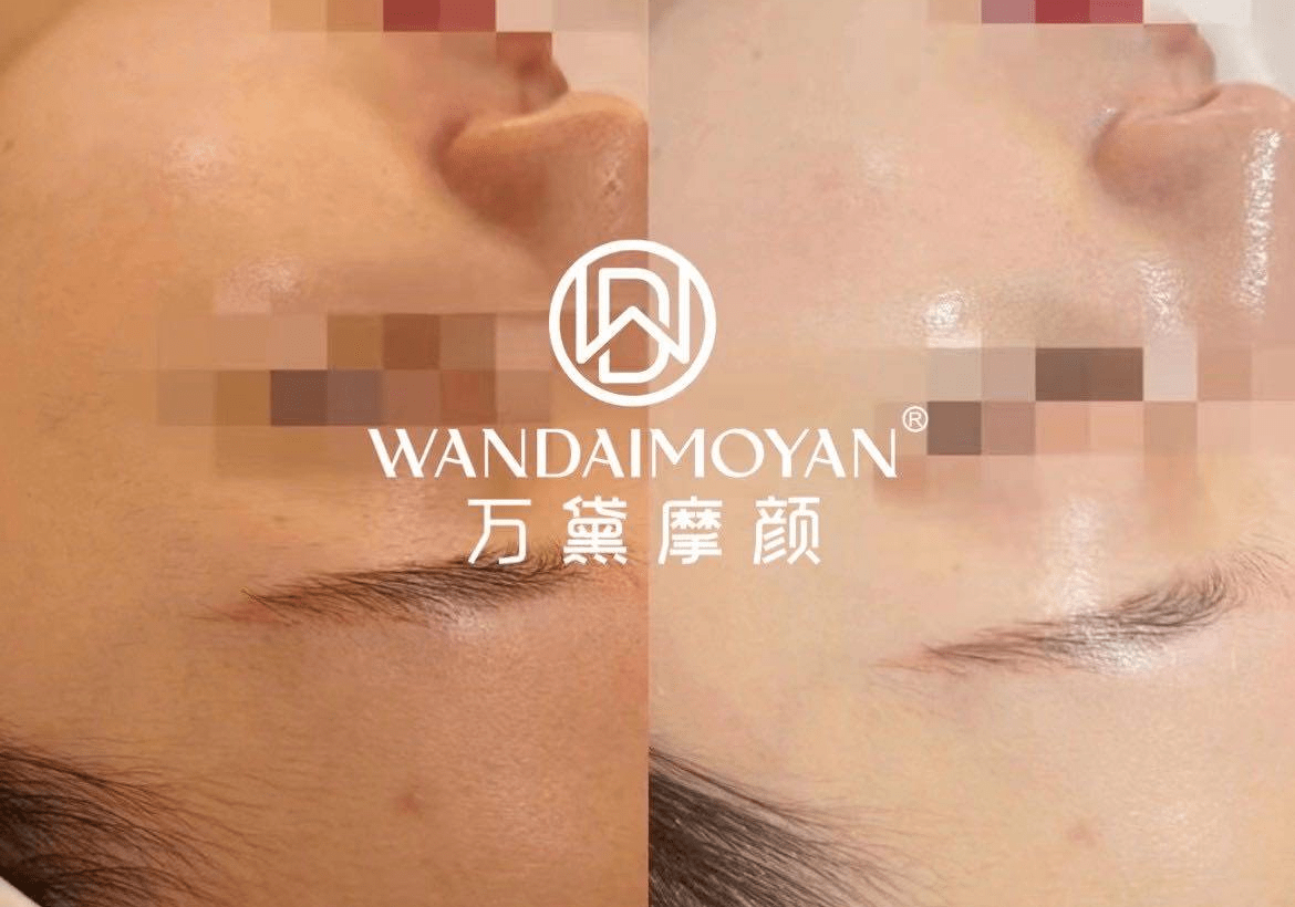 5g光波无痕祛斑术,万黛摩颜让你自信美_皮肤_技术_效果