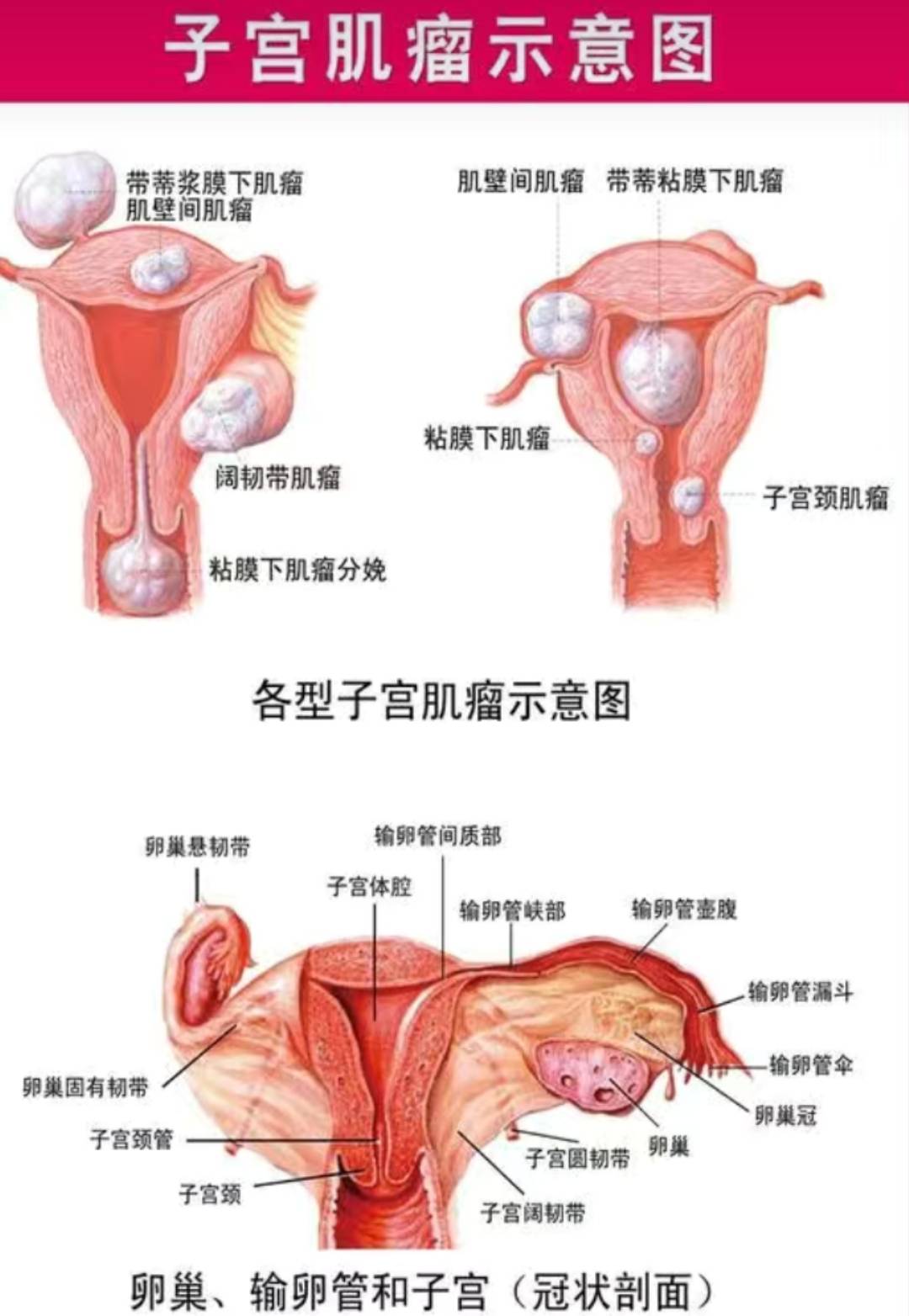 子宫阔韧带位置示意图图片