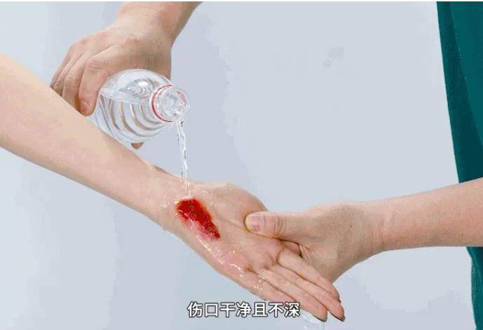 受伤流血如何清洗有伤口的地方呢?_自来水_红色_肥皂
