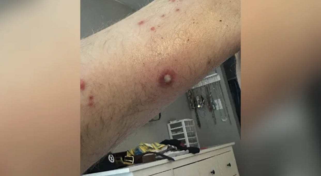美国加州一场障碍赛后爆发细菌感染 参赛选手浑身长满脓包_泥浆_索诺