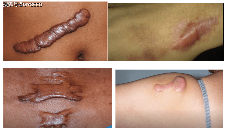 基因细胞激光疗法 (疤痕疙瘩/蟹足肿 keloid scar)的黏连性纤连蛋白疗