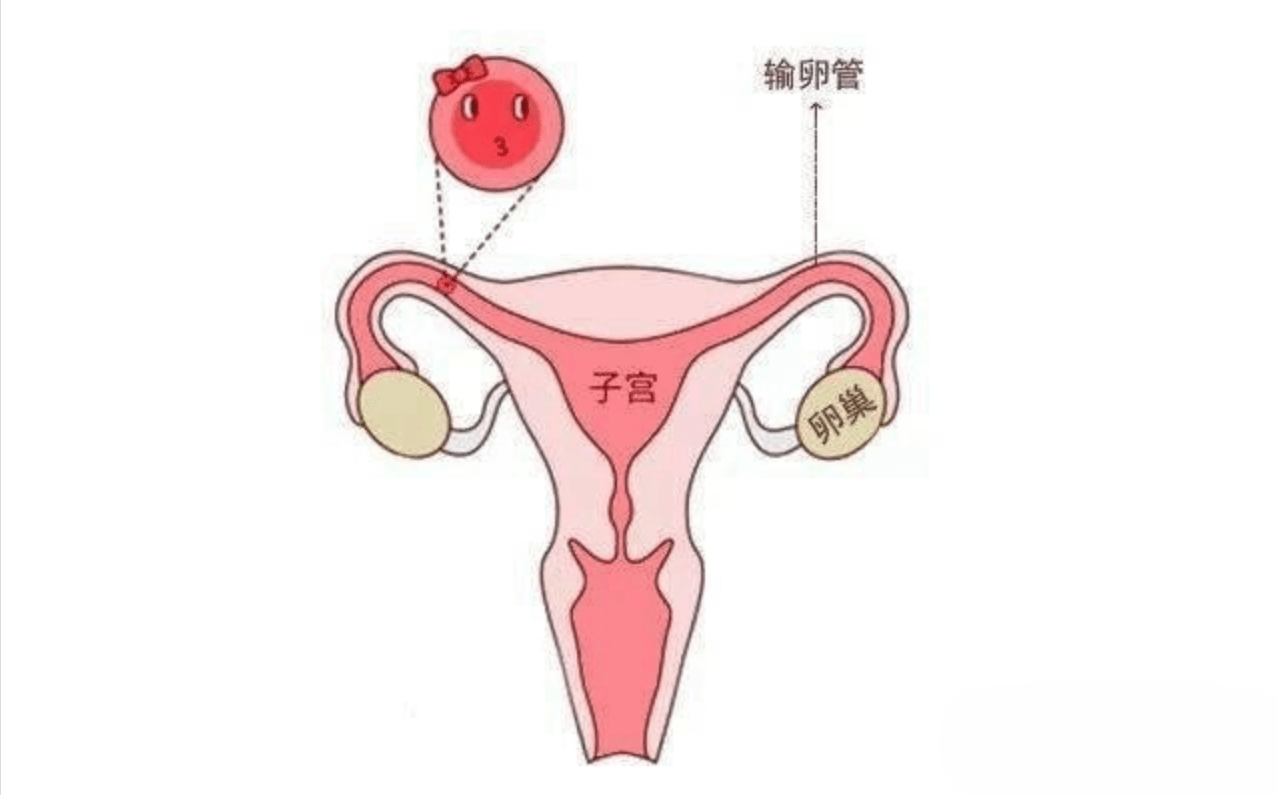 分享3种输卵管粘连常用的检查方法_治疗_造影_女性