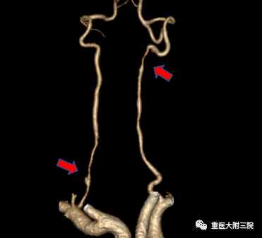 重醫三院醫療動態謹防青年腦卒中頭號殺手椎動脈頸動脈夾層