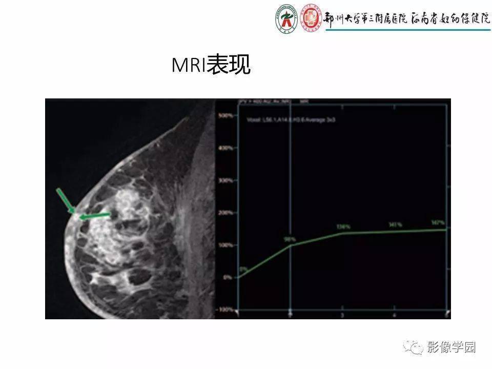 非哺乳期乳腺炎性病變與炎性乳癌影像診斷