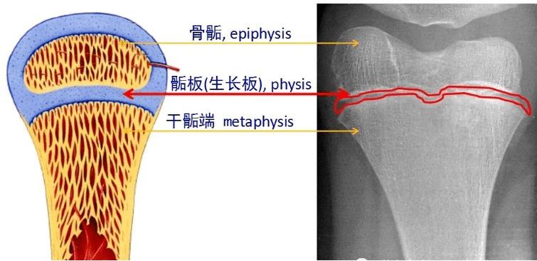 【技术分享】晋南分院骨科开展微创新技术——弹性髓内钉