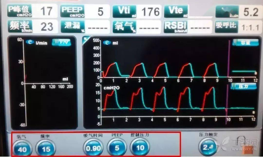 呼吸机吸呼比图片