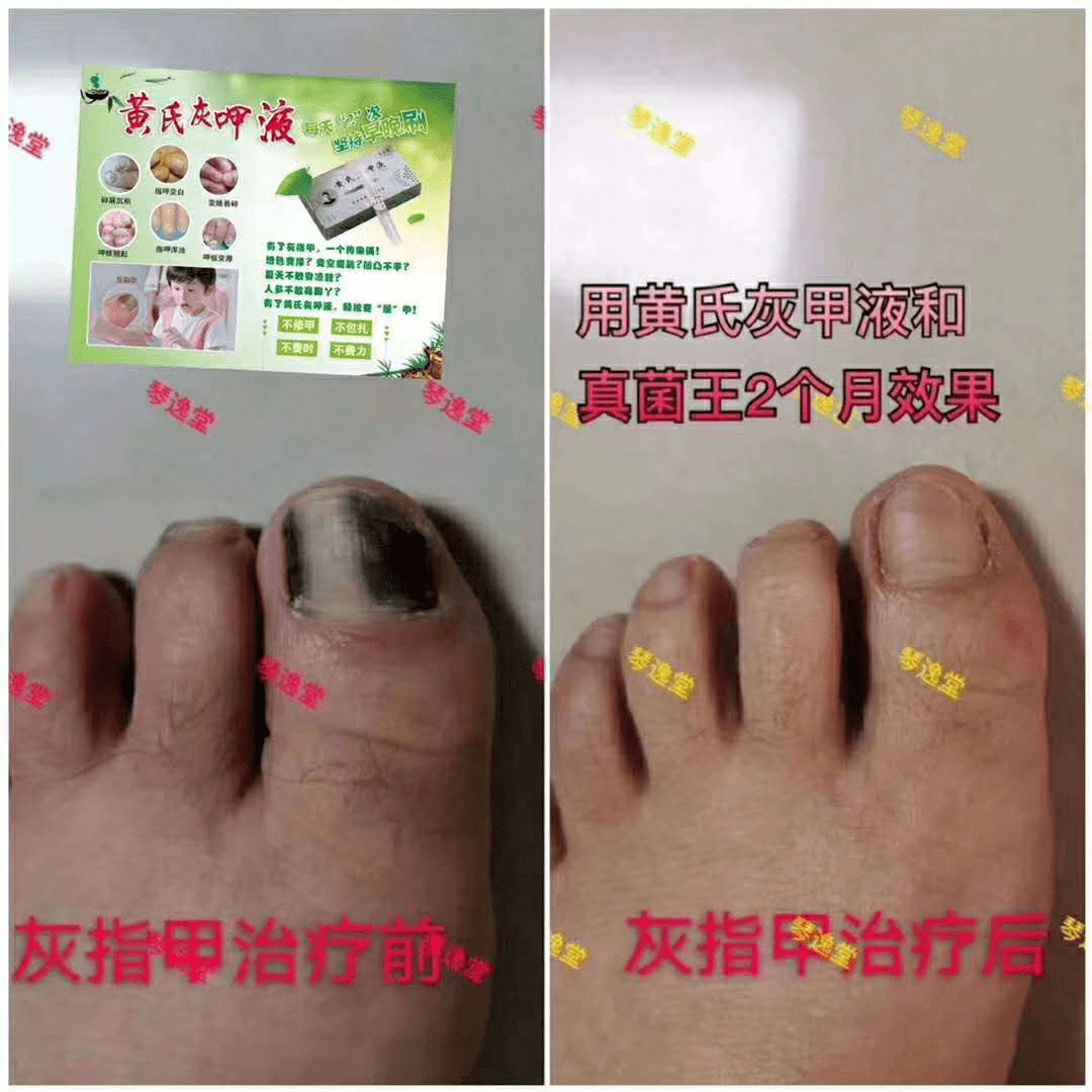 脚气和灰指甲该怎么治疗