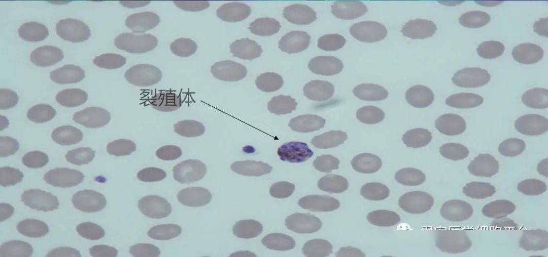 图片讨论顾剑飞老师:在涂片镜检时,发现有白细胞吞噬裂殖体的现象