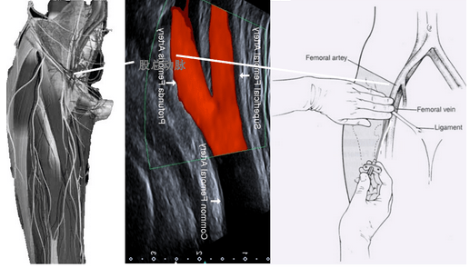 femoral artery图片