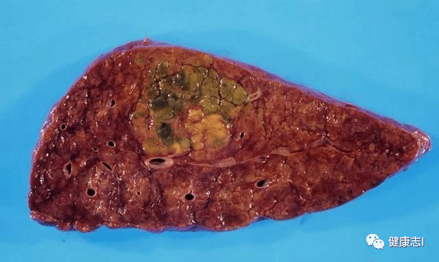 5,循环障碍(淤血)性肝硬化 慢性充血性心力衰竭,慢性缩窄性心包炎等