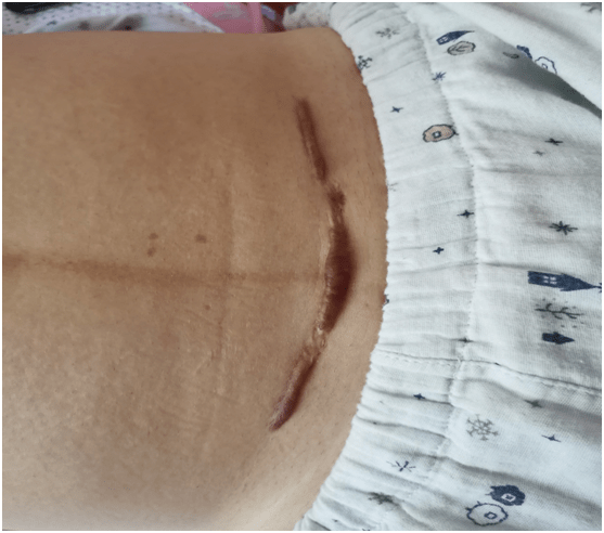手术过程虽然很顺利,但是由于自己本身有点瘢痕体质,留在肚子上的疤痕