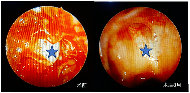 鼻子里流出来的"水样涕"竟然是脑脊液——我院耳鼻咽喉头颈外科成功