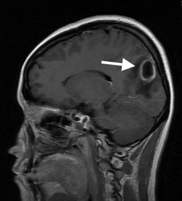 小鱼脑内的脑脓肿